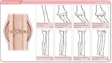 Informing Paediatric Orthopaedic Nursing Practice A Scoping Review of Outcome Measures for Childrens Upper Limb Fractures