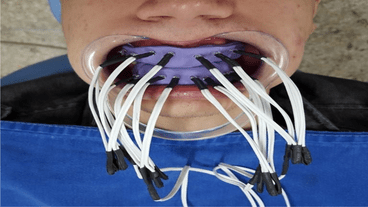 LED photobiomodulation effect on the bleaching-induced sensitivity with hydrogen peroxide 35 - a controlled randomized clinical trial