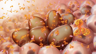 Multiple Myeloma with Central Nervous System relapse A case report