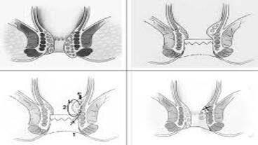 Pre-Operative Preparation of Hemorrhoid Surgery Using Tnds Vertical Ligation - Mucopexy Method at Hanoi Medical University Hospital