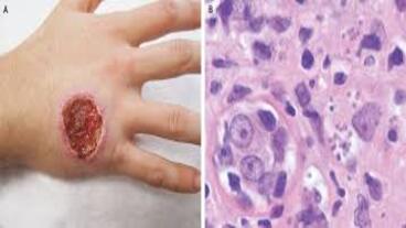 Updates on Cutaneous Leishmaniasis