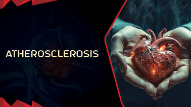 Peers Alley Media: Atherosclerosis