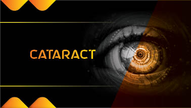 Peers Alley Media: Cataract