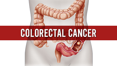 Peers Alley Media: Colorectal Cancer